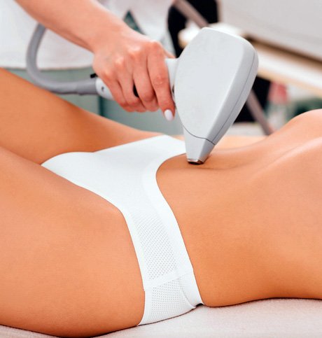 αποτρίχωση laser